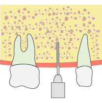 歯の根の治療に使うファイルという器具で、所定の深さまで骨に穴を開けます。